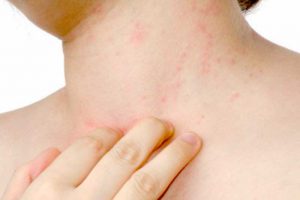 ALLERGIES CUTANÉES : ON LEUR FAIT LA PEAU…