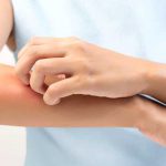 ECZÉMA : COMMENT SOIGNER LES PEAUX ATOPIQUES