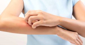 Eczéma et peau atopique : solutions naturelles et médicales pour apaiser les poussées ECZÉMA : COMMENT SOIGNER LES PEAUX ATOPIQUES