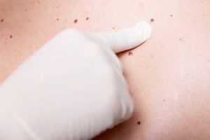 DE L’IMPORTANCE DE L’AUTO EXAMEN DES GRAINS DE BEAUTÉ