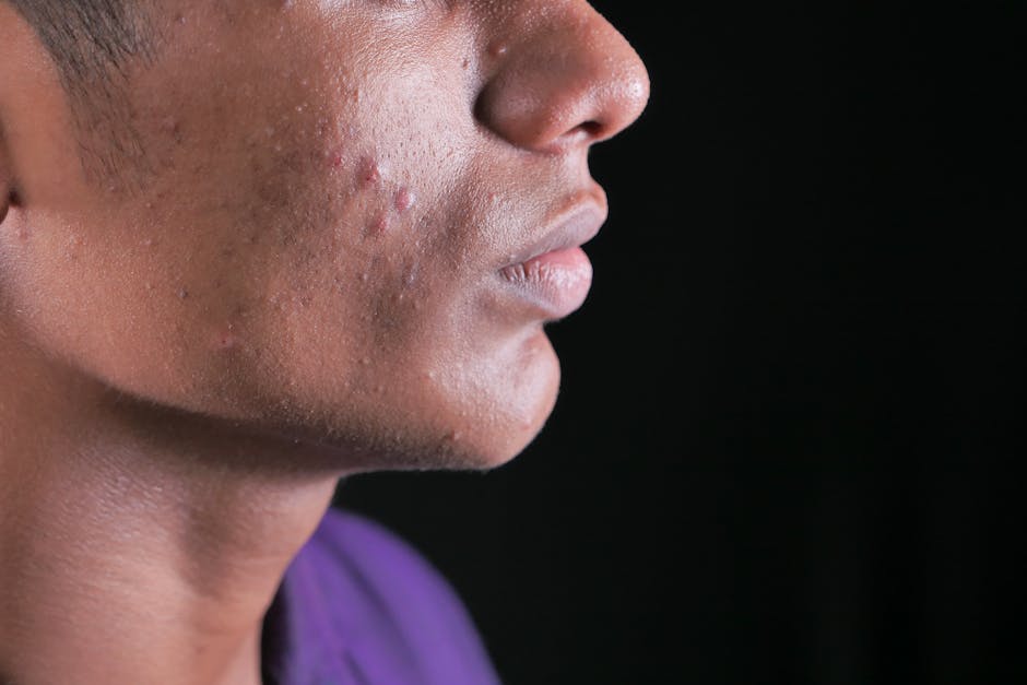 Taches cutanées : origines, types et comment les atténuer efficacement young woman skin with post acne dark spots macro photography