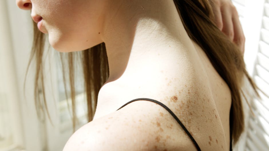 Peaux claires en été : 5 défis cutanés à connaître (et comment y faire face) skin pigmentation spots freckles fair skin sunlight